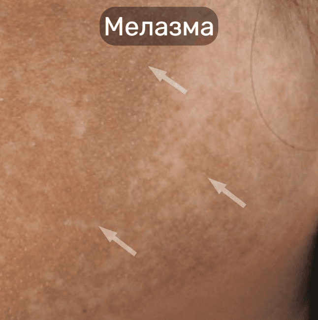 Пигментация, как победить?